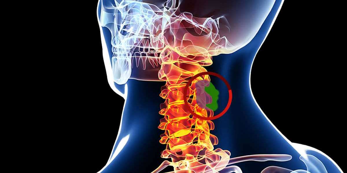 Metastases Spinal Tumor Market Trends To Chart Positive Growth With 3.9% CAGR By 2030