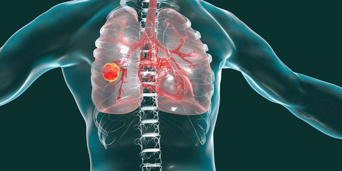 Lung Cancer Know The Symptoms And Causes Of Lung Cancer