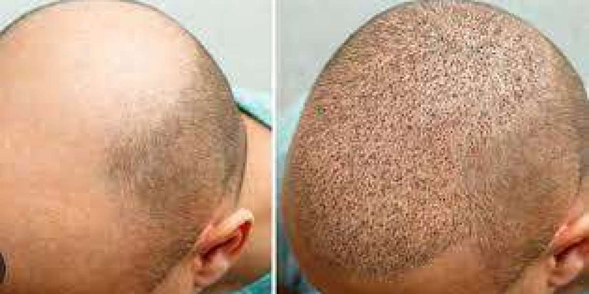 Deciphering Hair Transplant Costs in Riyadh: A Comprehensive Guide