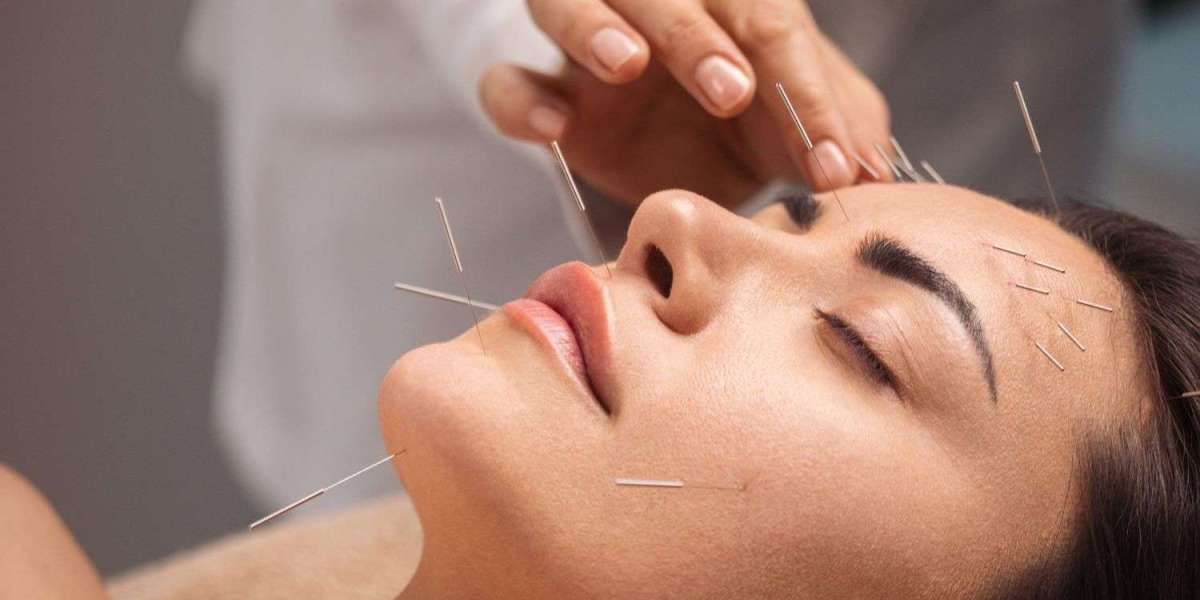 How Acupuncture Therapy Can Relieve Chronic Pain: Your Ultimate Guide