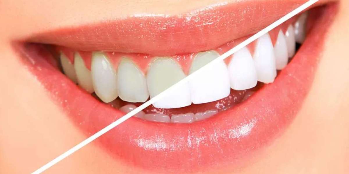 Brighten Your Smile: Great Teeth Whitening Services in Troy, MI