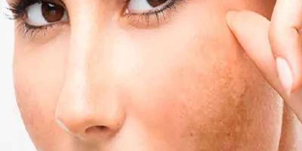 Melasma Solutions: What Dubai Experts Recommend