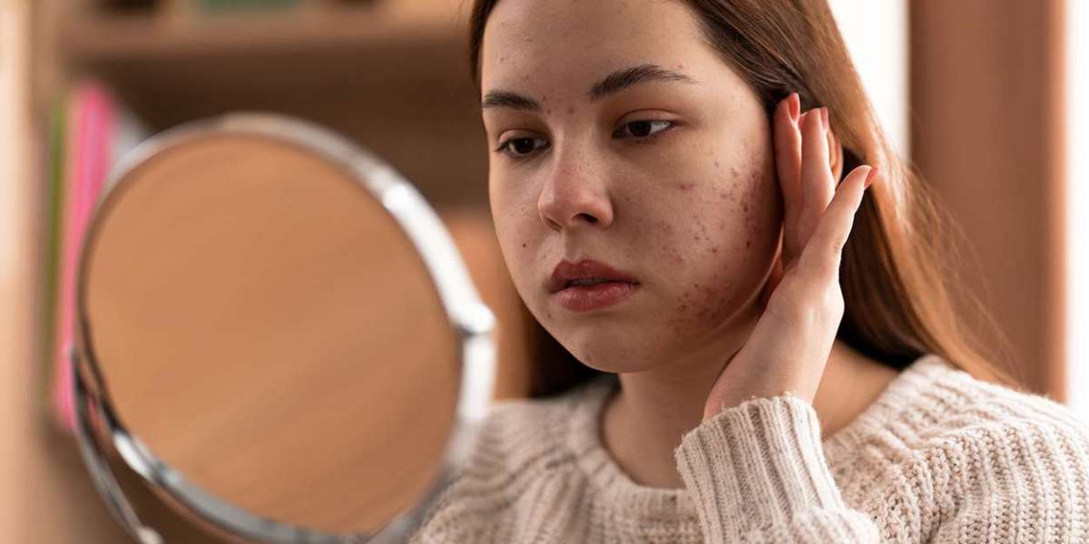 Top 10 Proven Remedies to Banish Acne Blemishes Fast