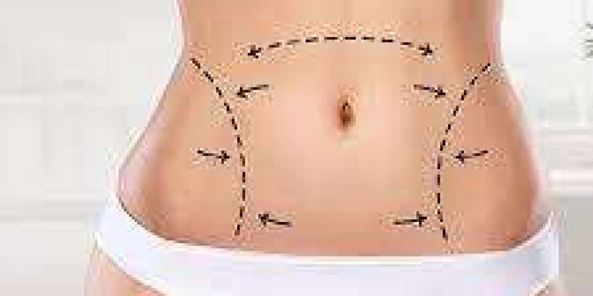 Choosing the Right Liposuction Procedure: A Guide for Abu Dhabi Residents