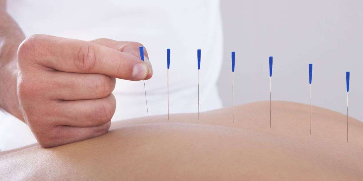 Transforming Your Life: A Deep Dive into Acupuncture for Back Pain Relief