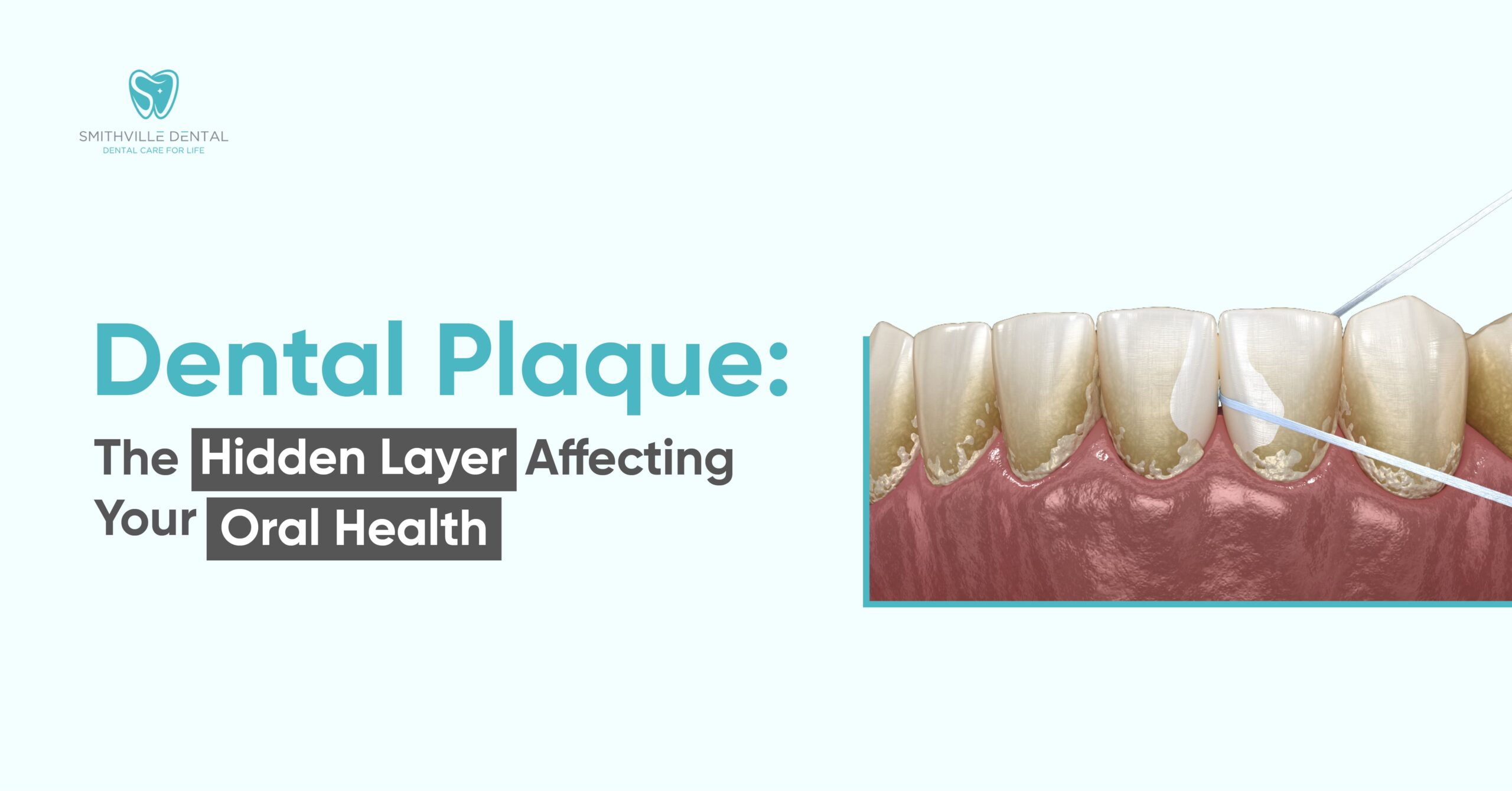 Dental Plaque: The Hidden Layer Affecting Your Oral Health | Smithville Dental