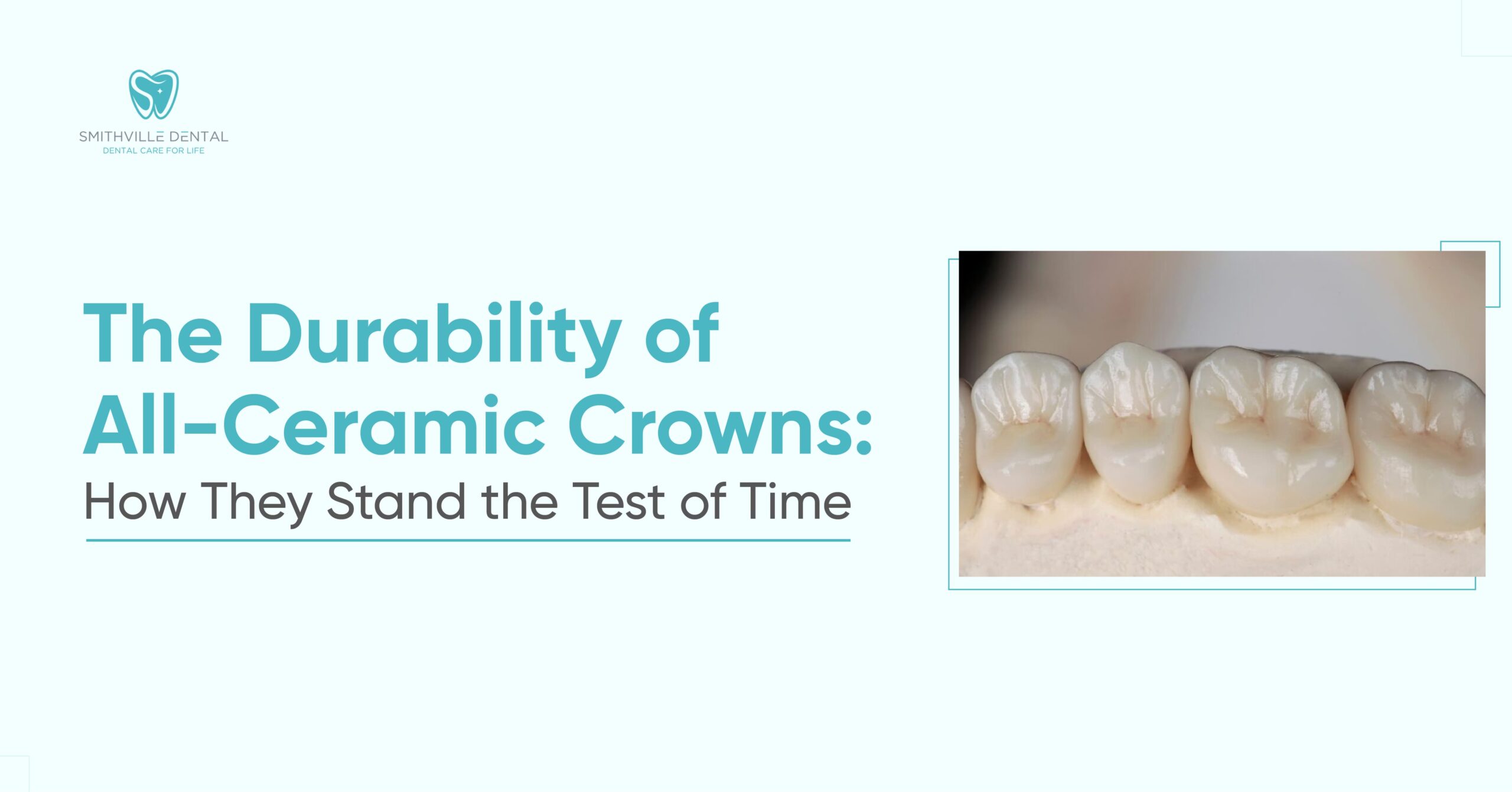 The Durability of All-Ceramic Crowns: How They Stand the Test of Time