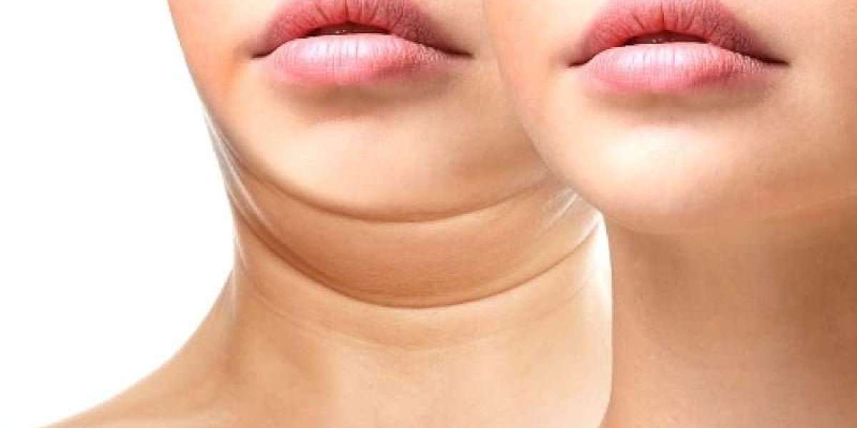 Smooth, Tighten, and Define Your Chin with Double Chin Solutions