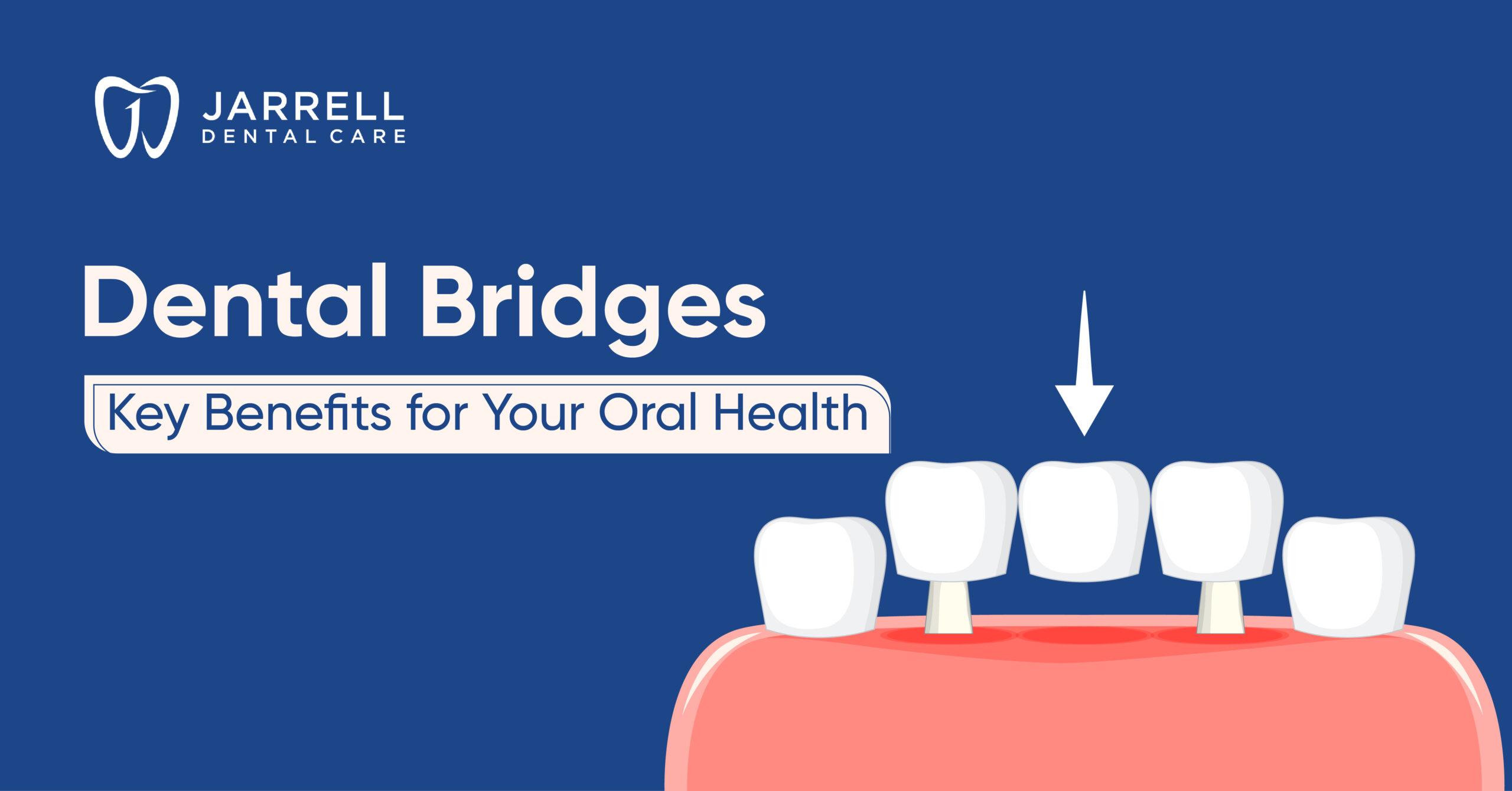 Dental Bridges Key Benefits for Your Oral Health | Jarrell Dental Care