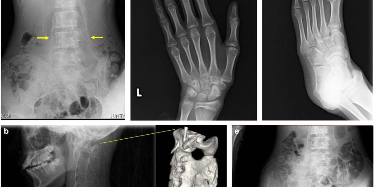 Fibrodysplasia Ossificans Progressiva Treatment Market Forecast and Future Growth Scenarios 2024 – 2032