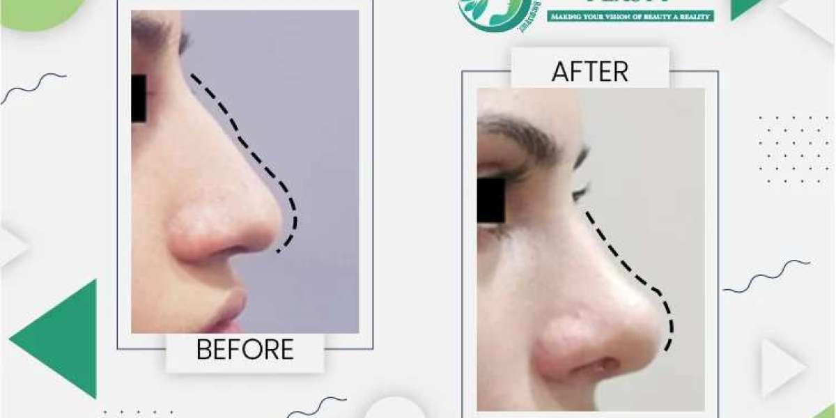 Factors Affecting the Nose Surgery Cost in Pakistan