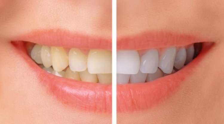 Achieve a Brighter Smile with Professional Teeth Whitening