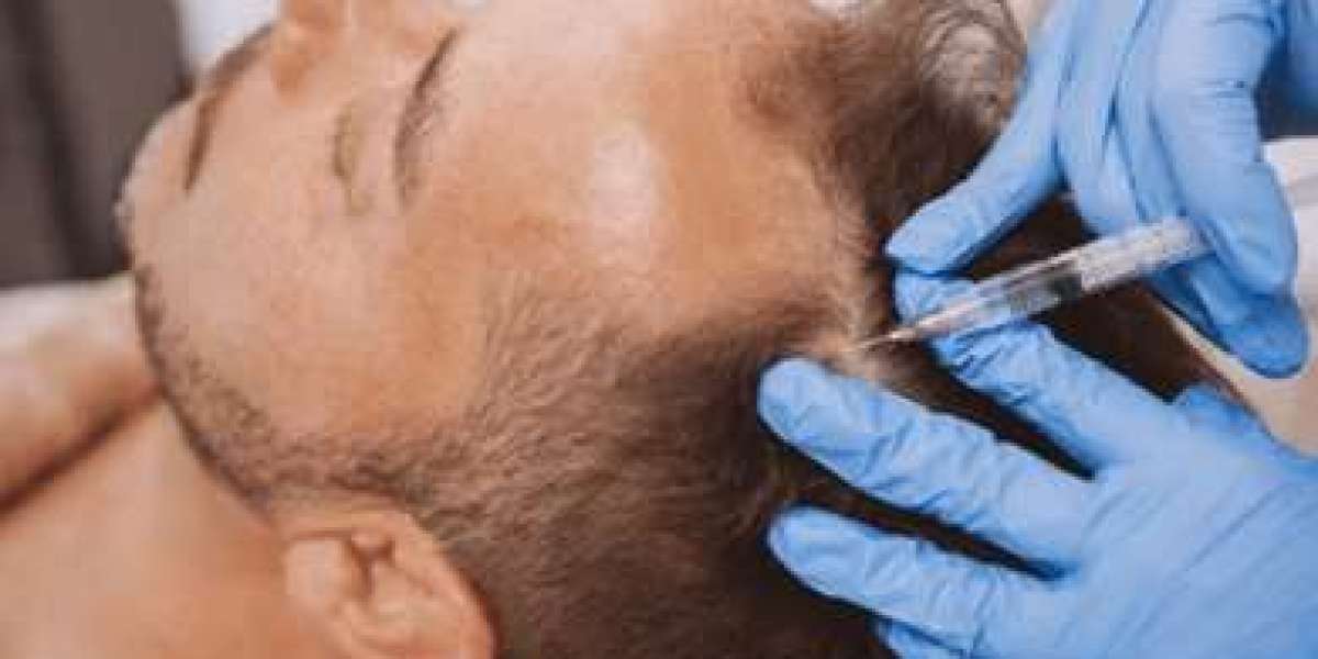 GFC Hair Treatment in Dubai: Restore Your Hairline Naturally