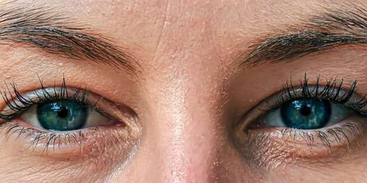 what are hooded eyes? its causes and treatments.