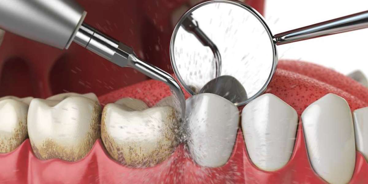 Dental Fillings: Everything You Need to Know