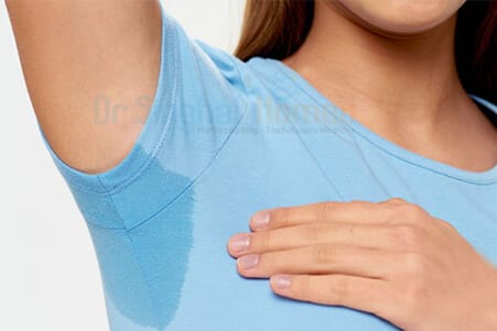 Hyperhidrosis Homeopathic Treatment for Excessive Sweating