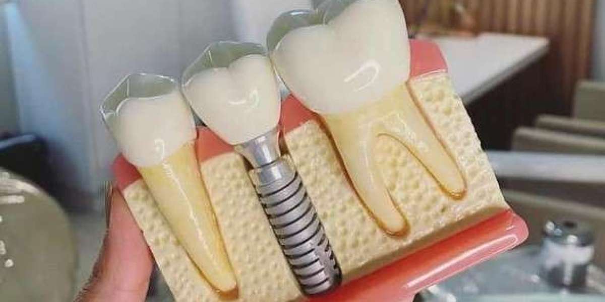 Can Smokers Get Dental Implants? Risks and Considerations